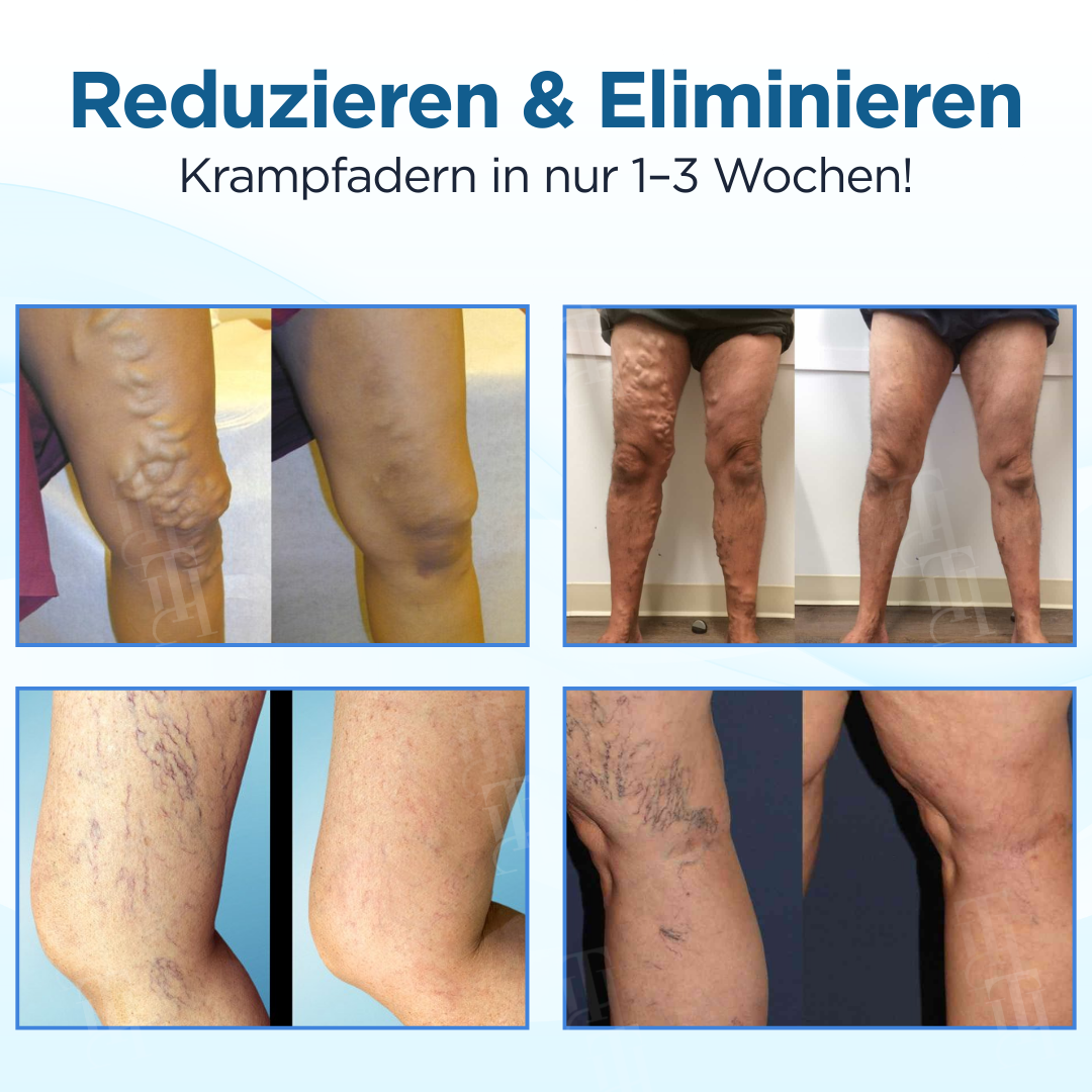 Cvreoz® Kräuter Krampfadern Behandlungsspray