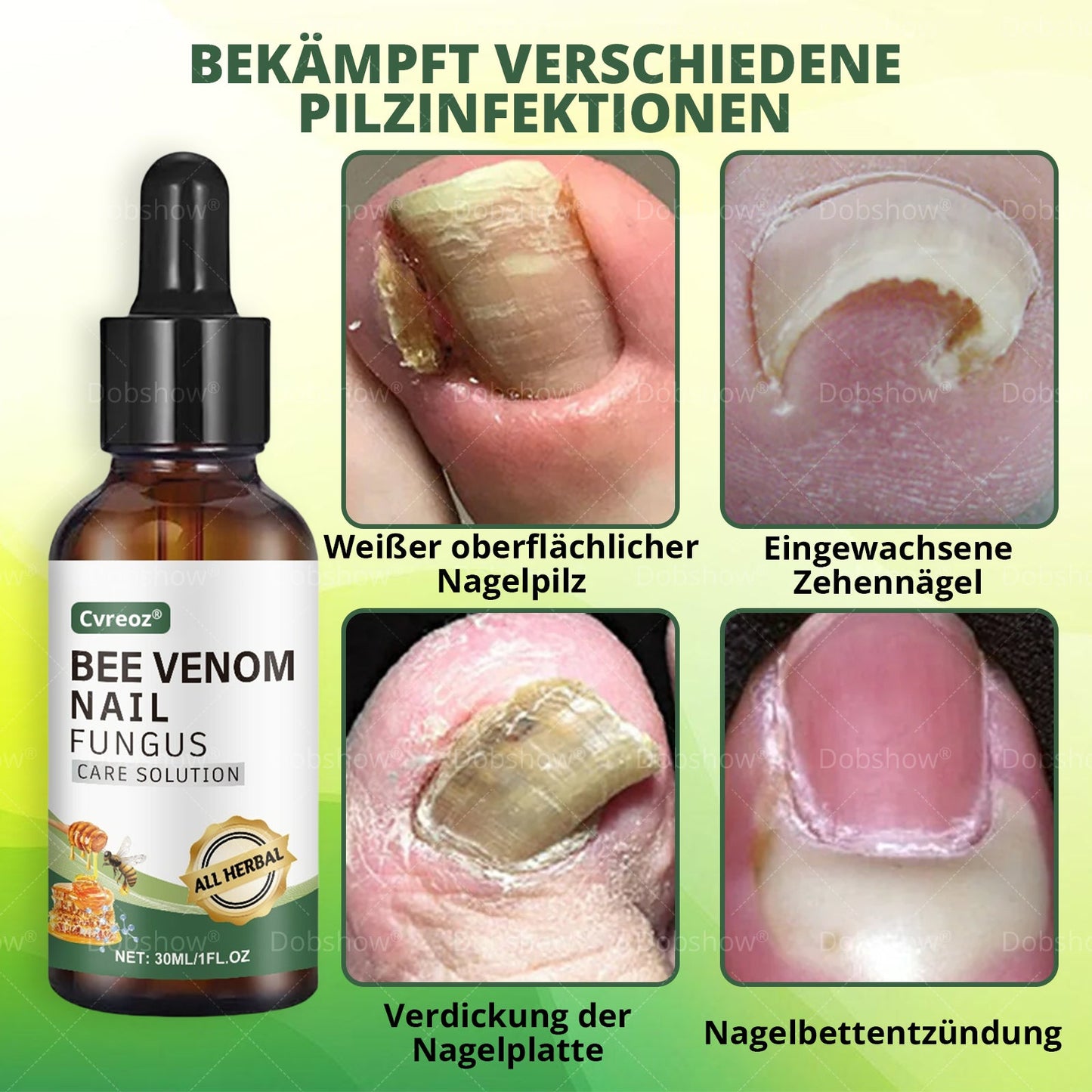 Cvreoz® Bienenvenen Nagelpflege bei Pilzbefall – Natürliche Lösung für gesunde Zehen- und Fingernägel