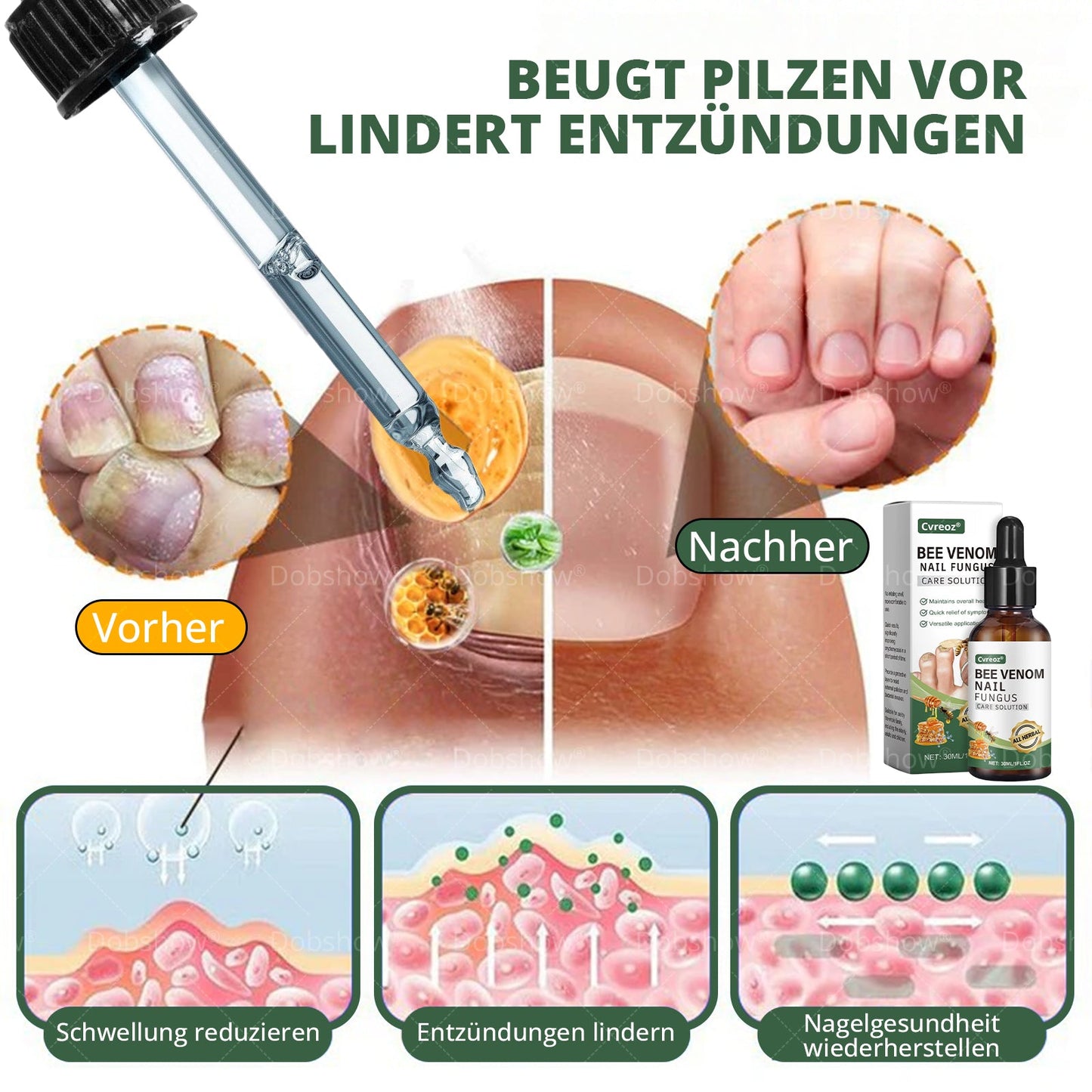 Cvreoz® Bienenvenen Nagelpflege bei Pilzbefall – Natürliche Lösung für gesunde Zehen- und Fingernägel