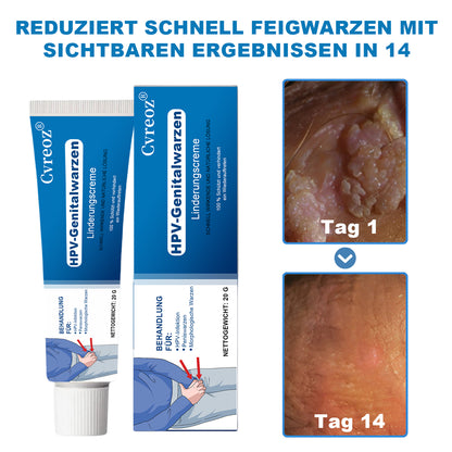 Cvreoz® HPV-Genitalwarzen