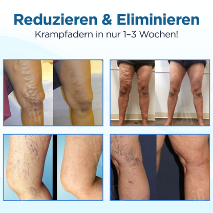 Cvreoz® Kräuter Krampfadern Behandlungsspray