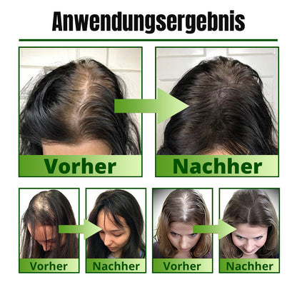 ⓒⓥⓡⓔⓞⓩ® Nourish & Flourish Haarwachstumsspray + 5%Minoxidil